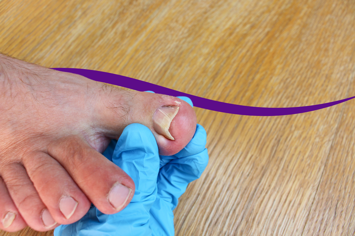 why-antibiotics-won-t-fix-your-ingrown-toenail