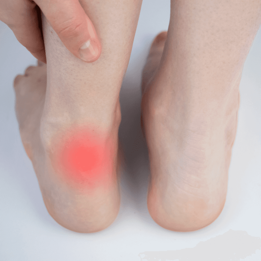 Heel Pain Treatment | FeetCare