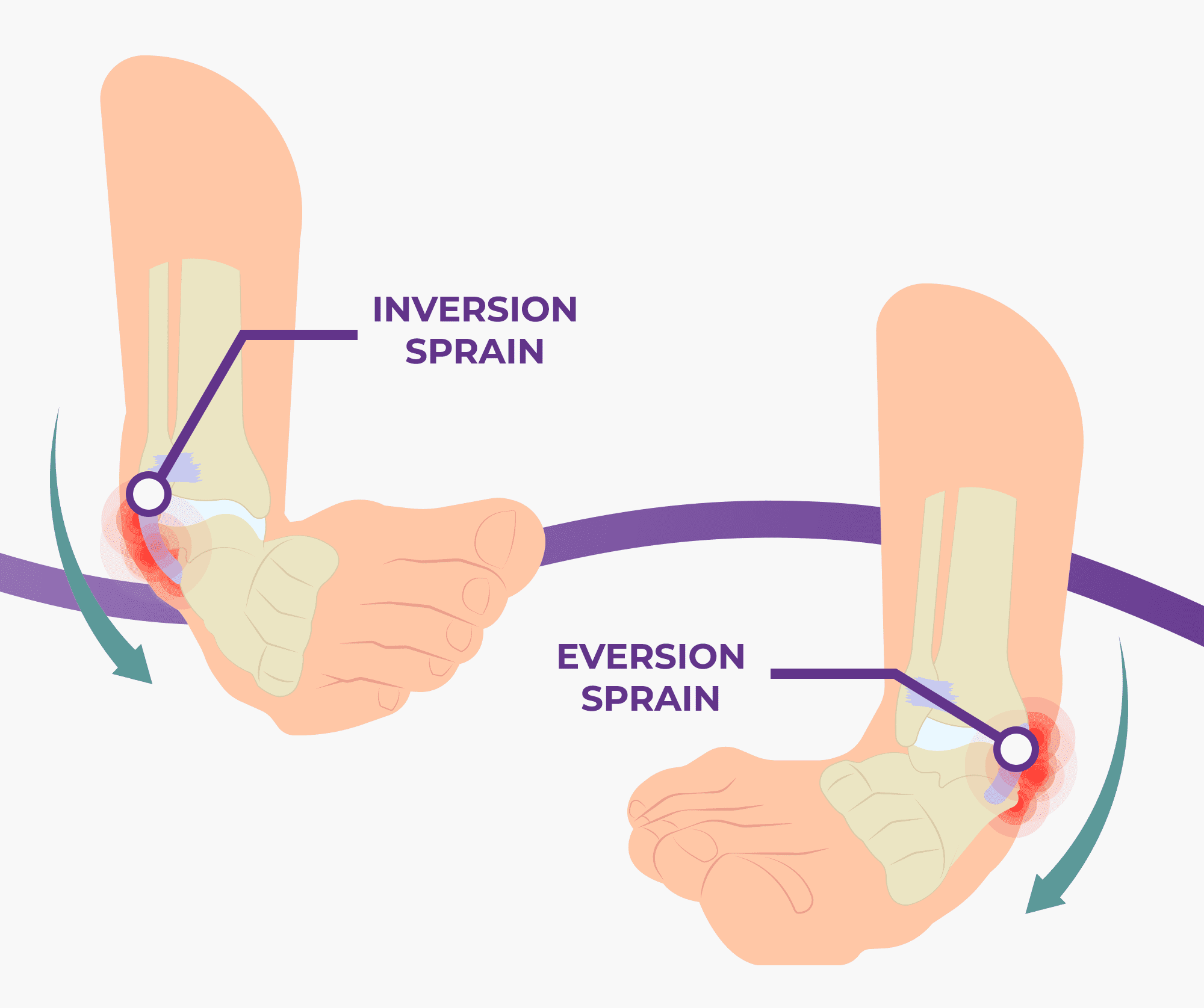 Ankle Sprains Causes Symptoms And Treatment