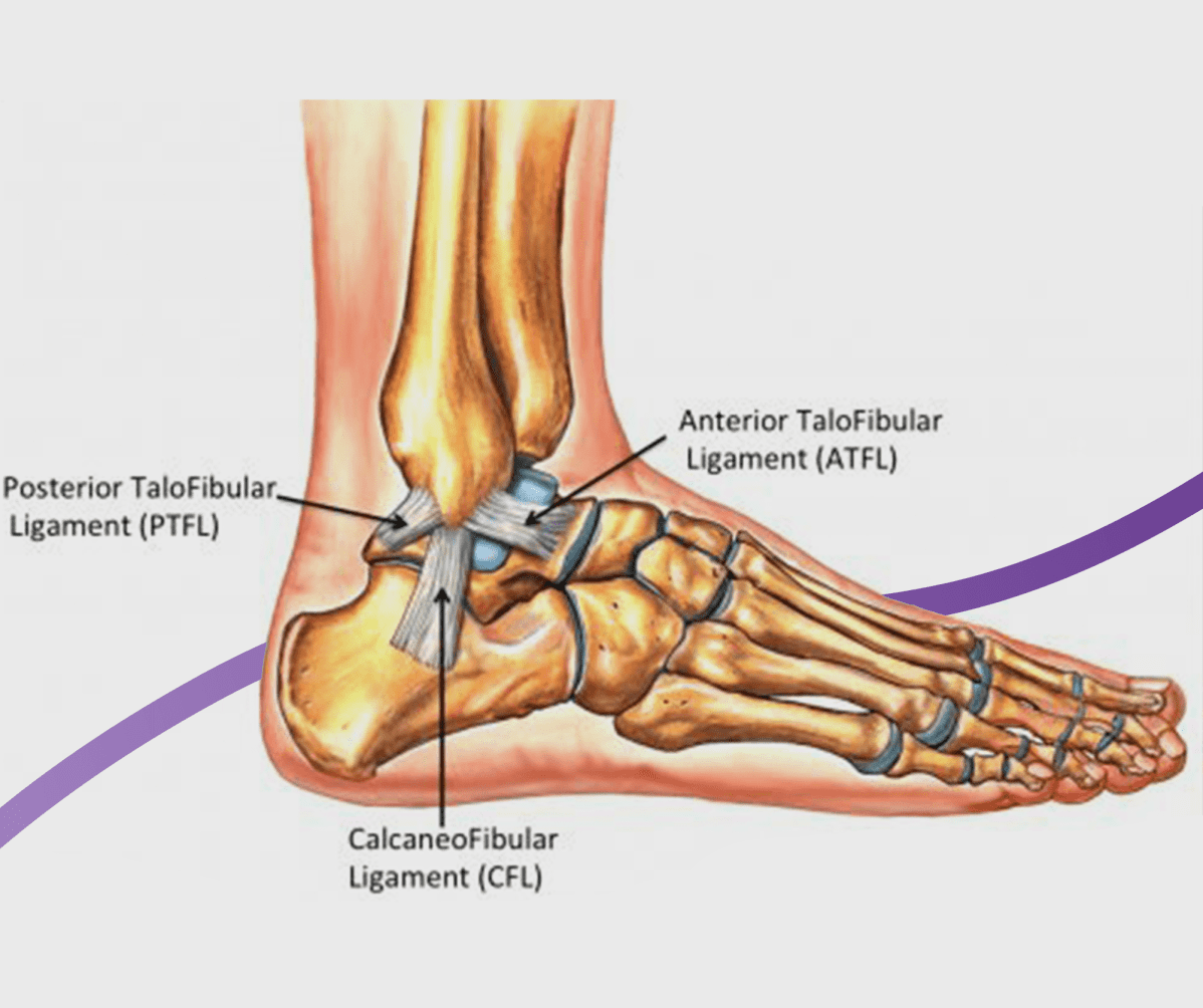 How to treat an eversion ankle sprain 