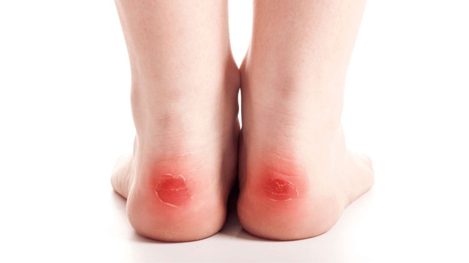 Shoe Rubs on the Back of Ankle: How to Prevent Discomfort