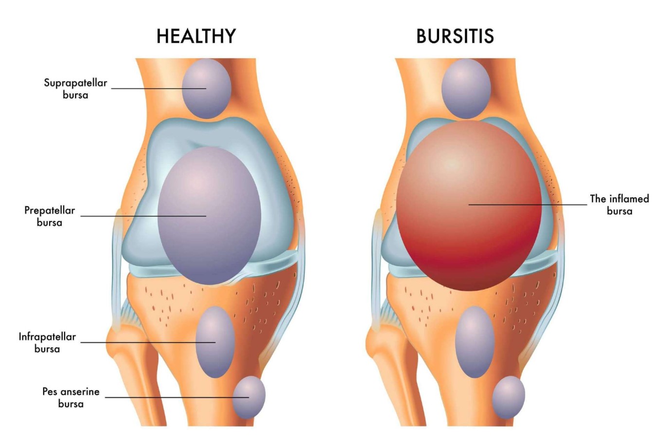 Diagram comparing a bursitis knee joint against a healthy knee joint
