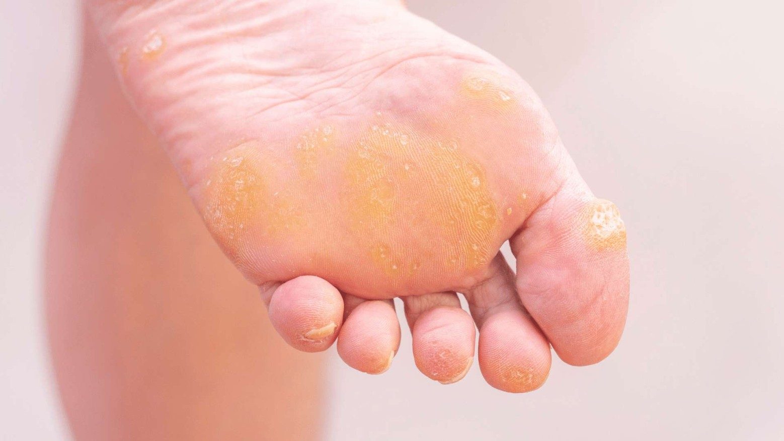 Thickened Skin on The Top of The Foot Symptoms & Causes | Buoy