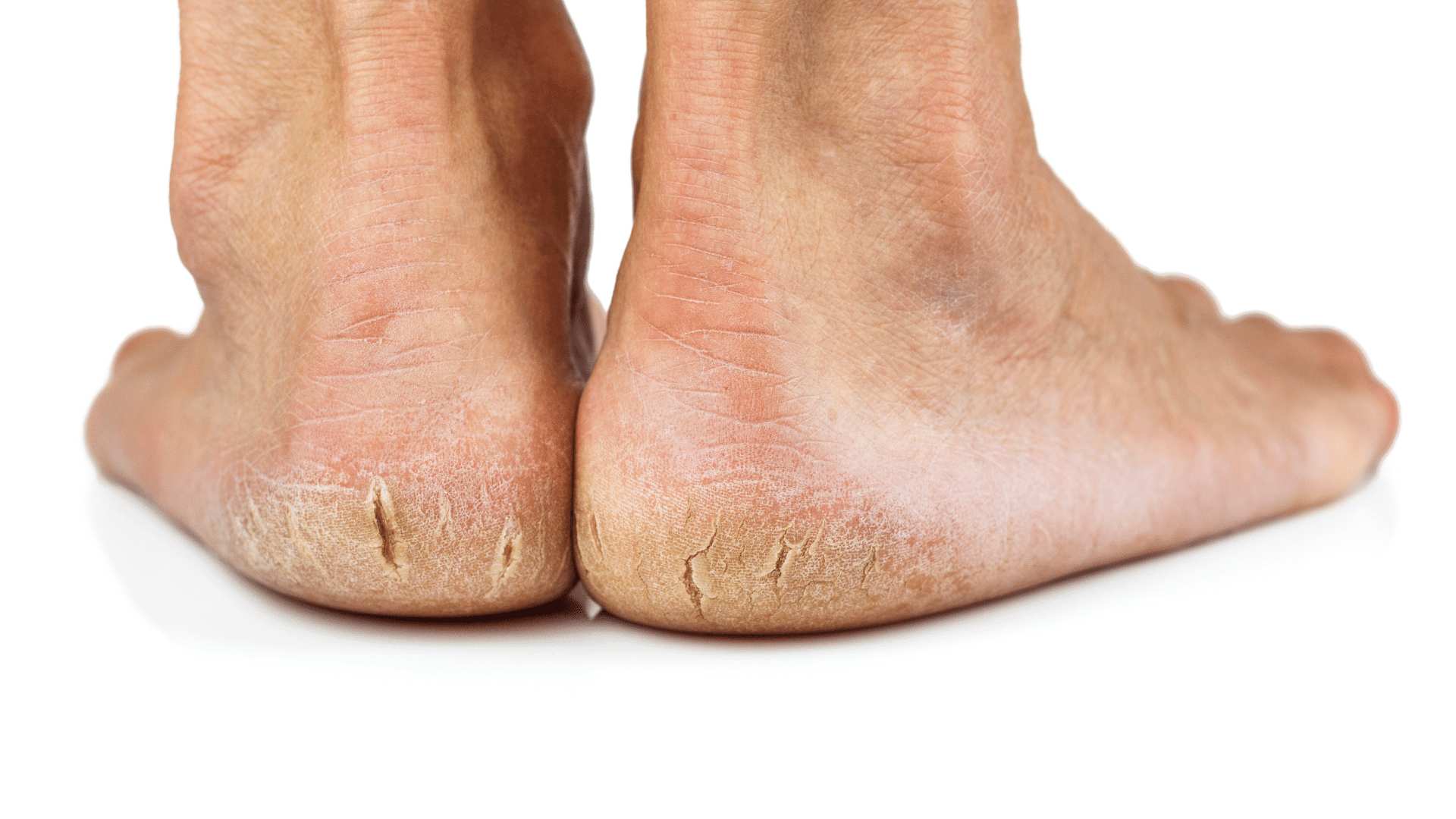 Cracked heels The back of two feet with severely cracked heels