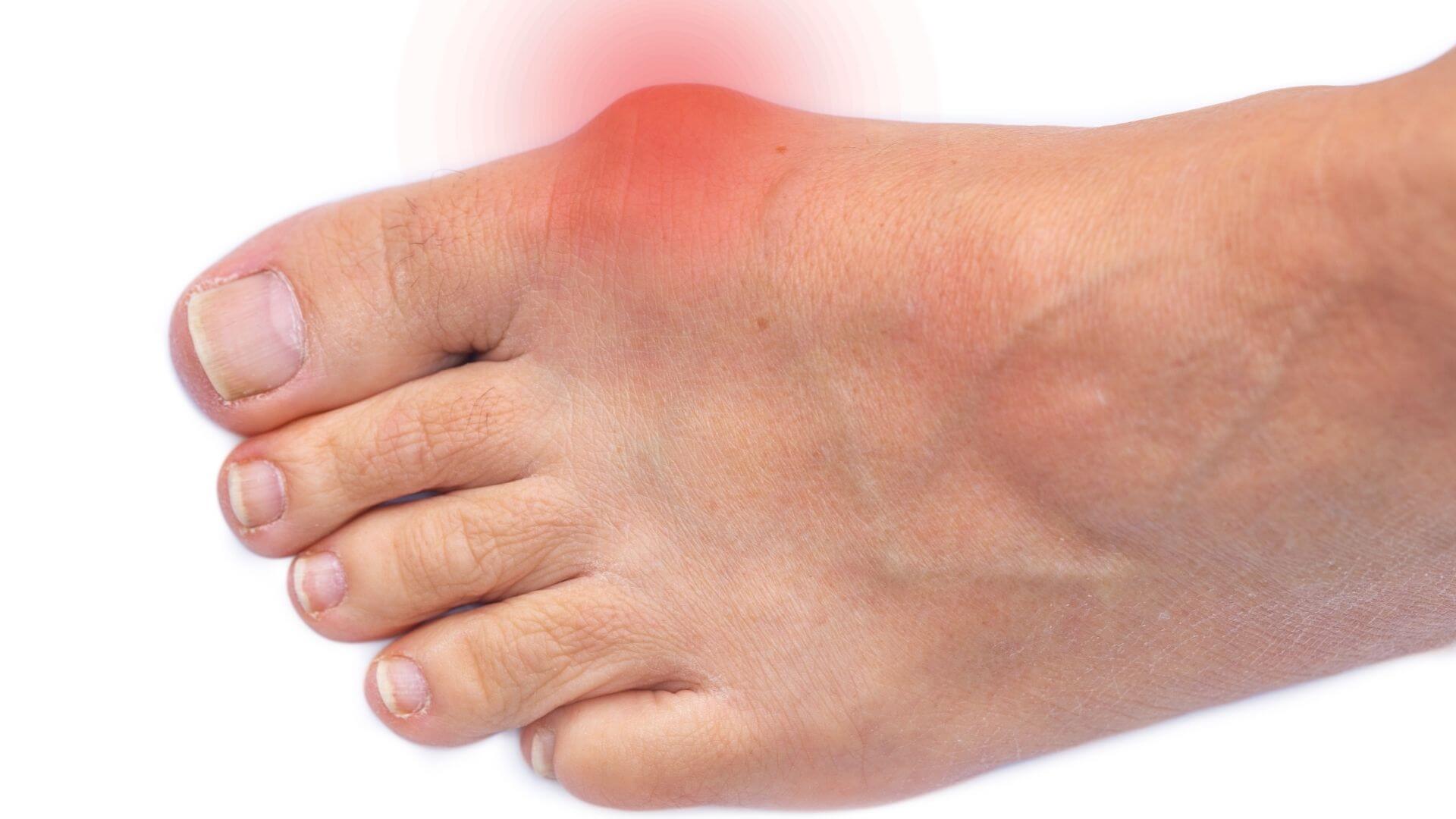 Bunions Surgery, Treatment, Symptoms & Causes The Feet People Podiatry