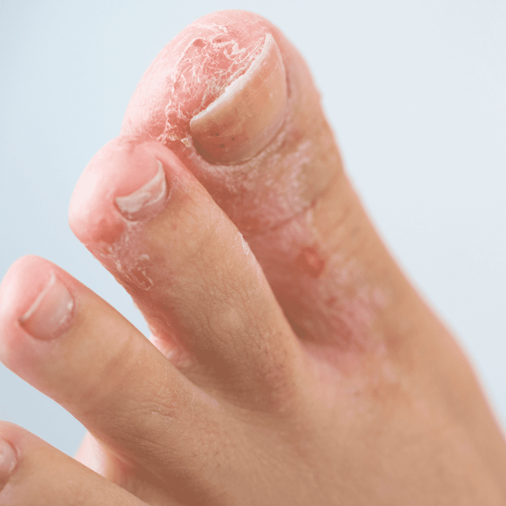 Athletes Foot Symptoms Causes And Treatment The Feet People