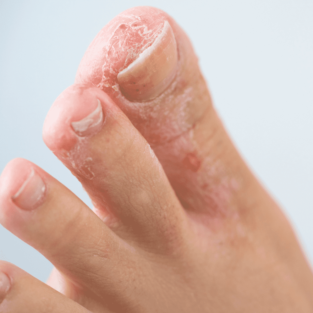 Athlete s Foot Symptoms Causes Treatment The Feet People