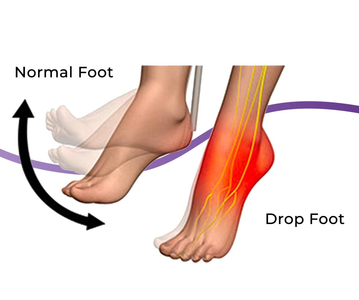 What is foot drop?