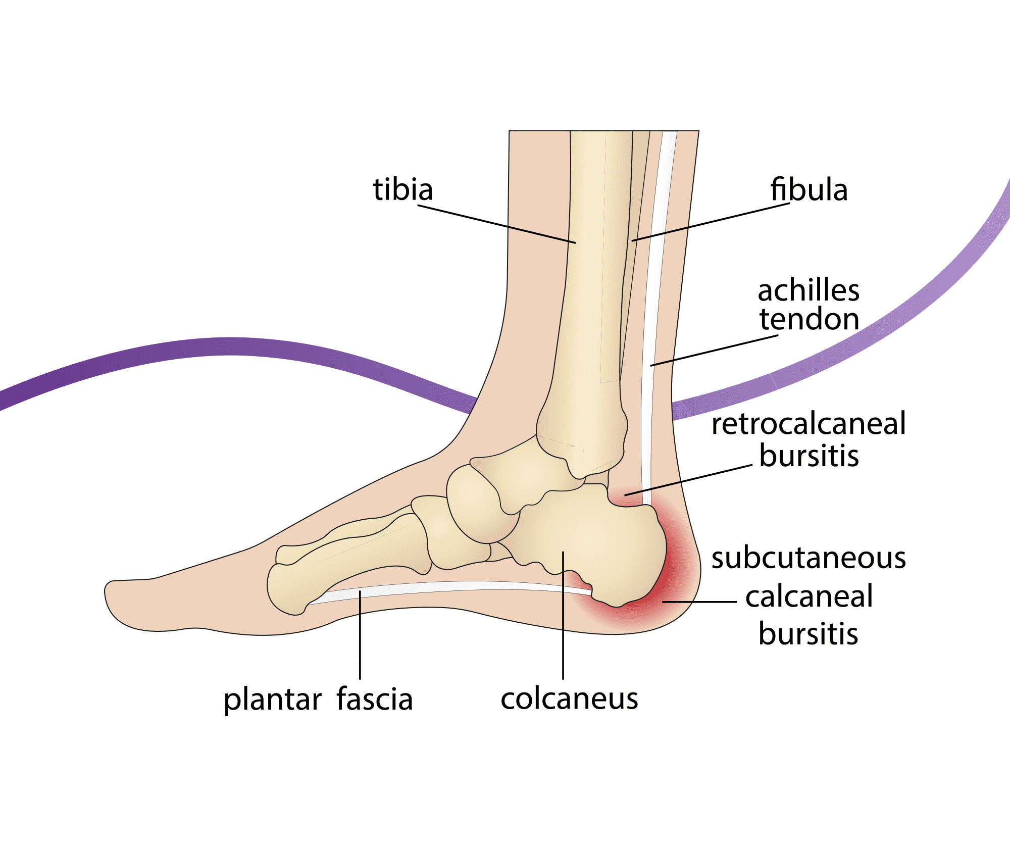 Haglund S Deformity Causes Symptoms Treatment The Feet People