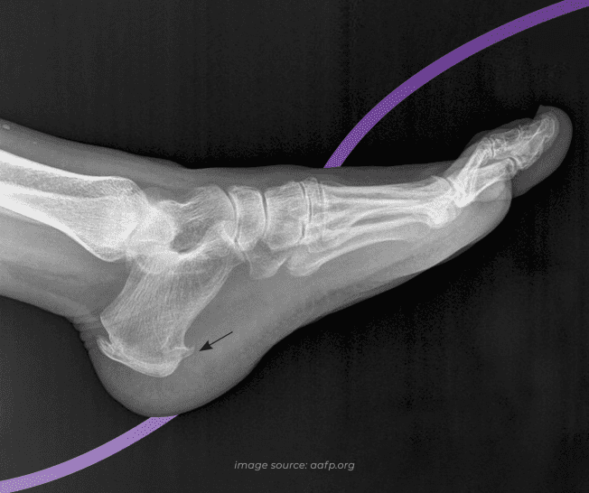 https://www.thefeetpeople.com.au/media/website_pages/symptoms-we-treat/heel-spur/Heel-Spur-radiograph_652x546a.png