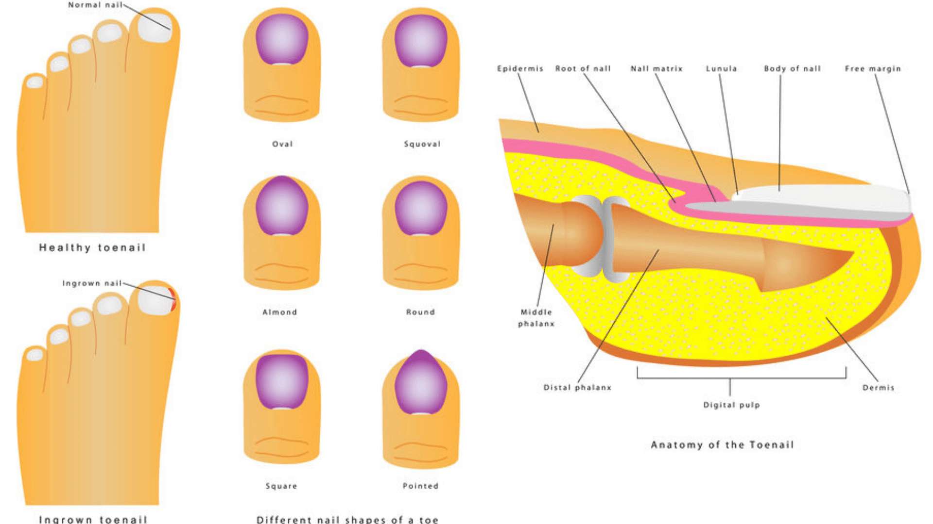 OnyFix: NZ's #1 Painless Ingrown Toenail Treatment | Vital Feet Podiatry  Tauranga