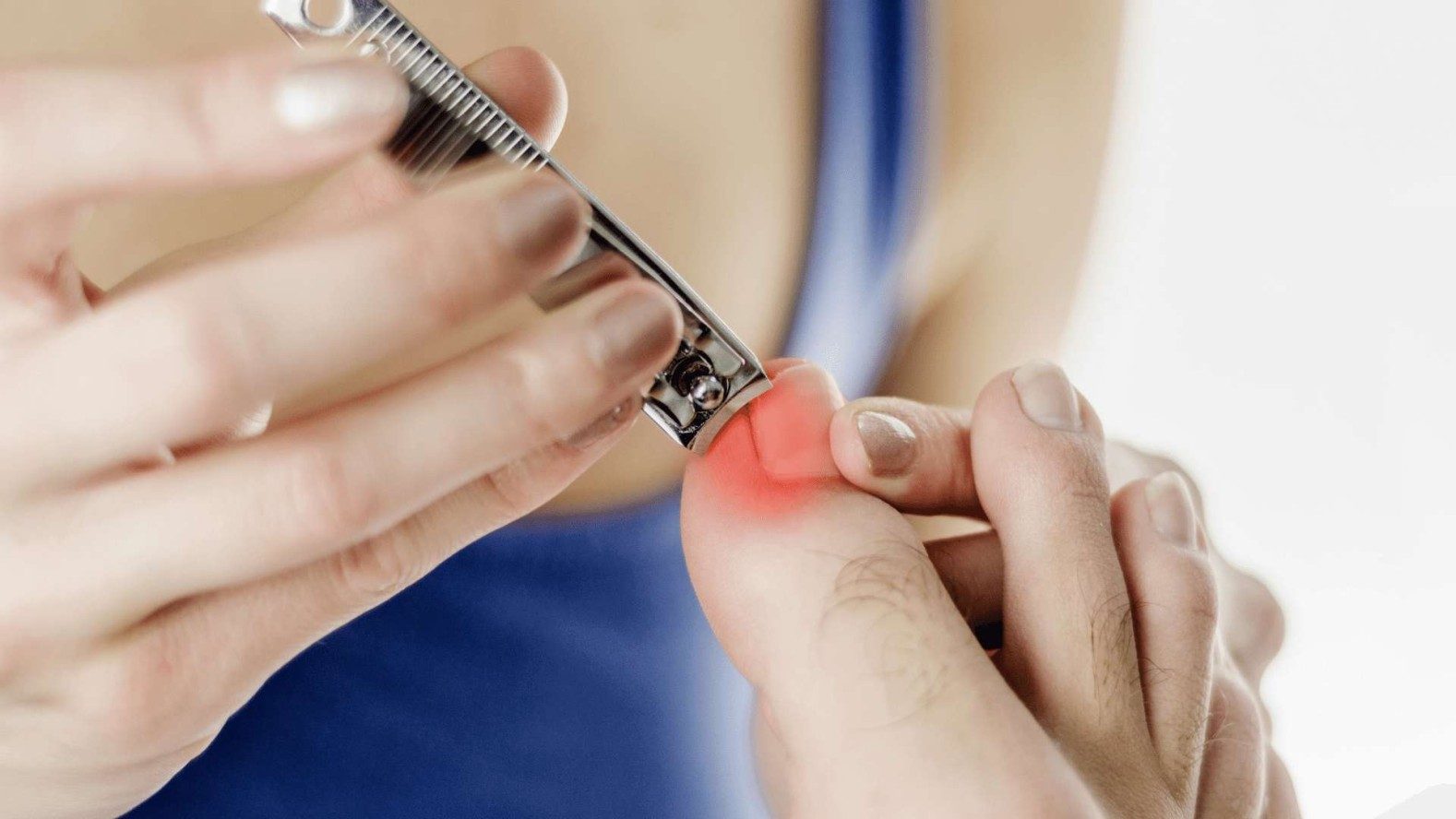 What Is an Ingrown Nail and How Should It Be Treated? - GoodRx
