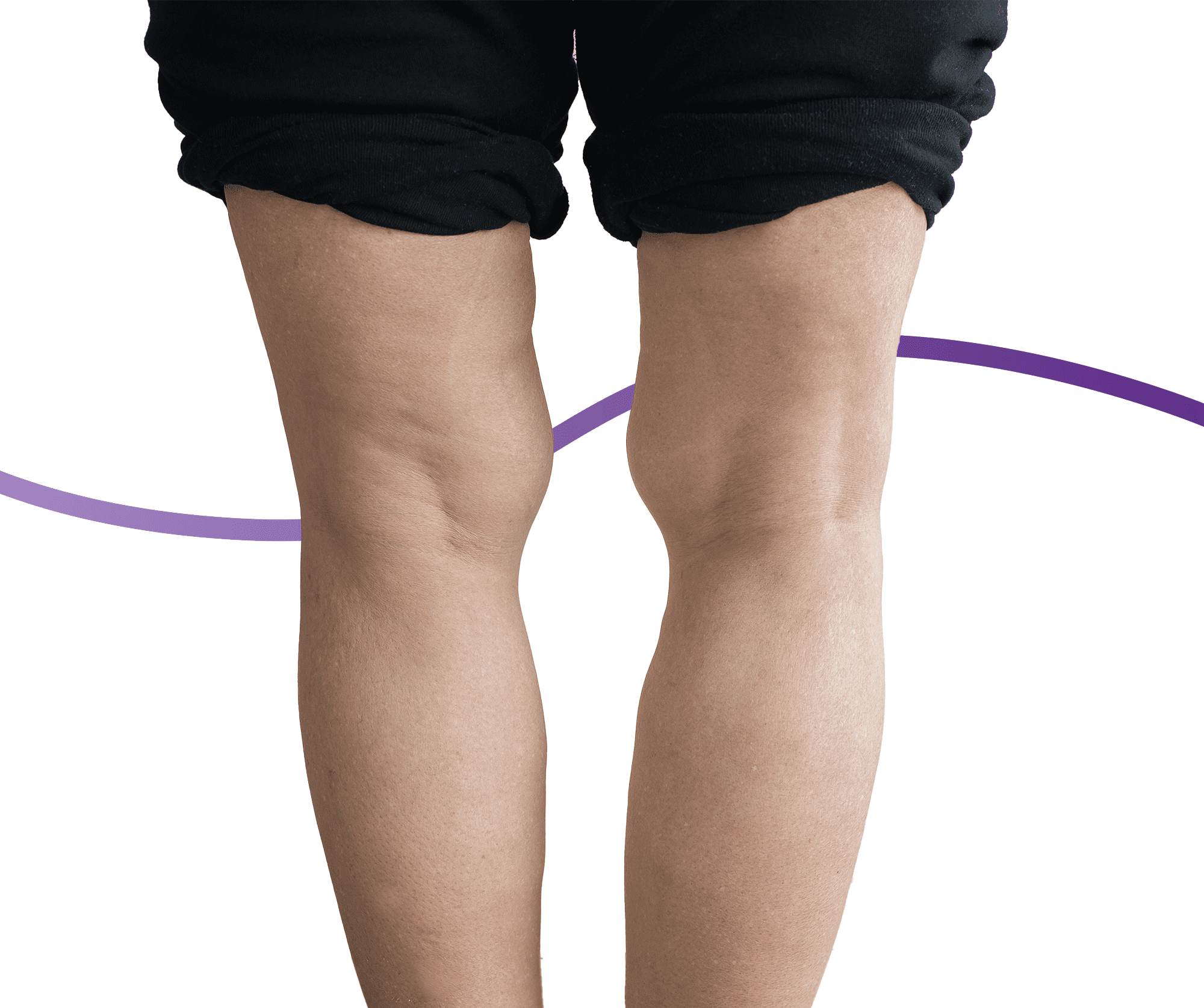 Knocked Knees (Genu Valgum): Causes, Symptoms & Treatment | The Feet ...