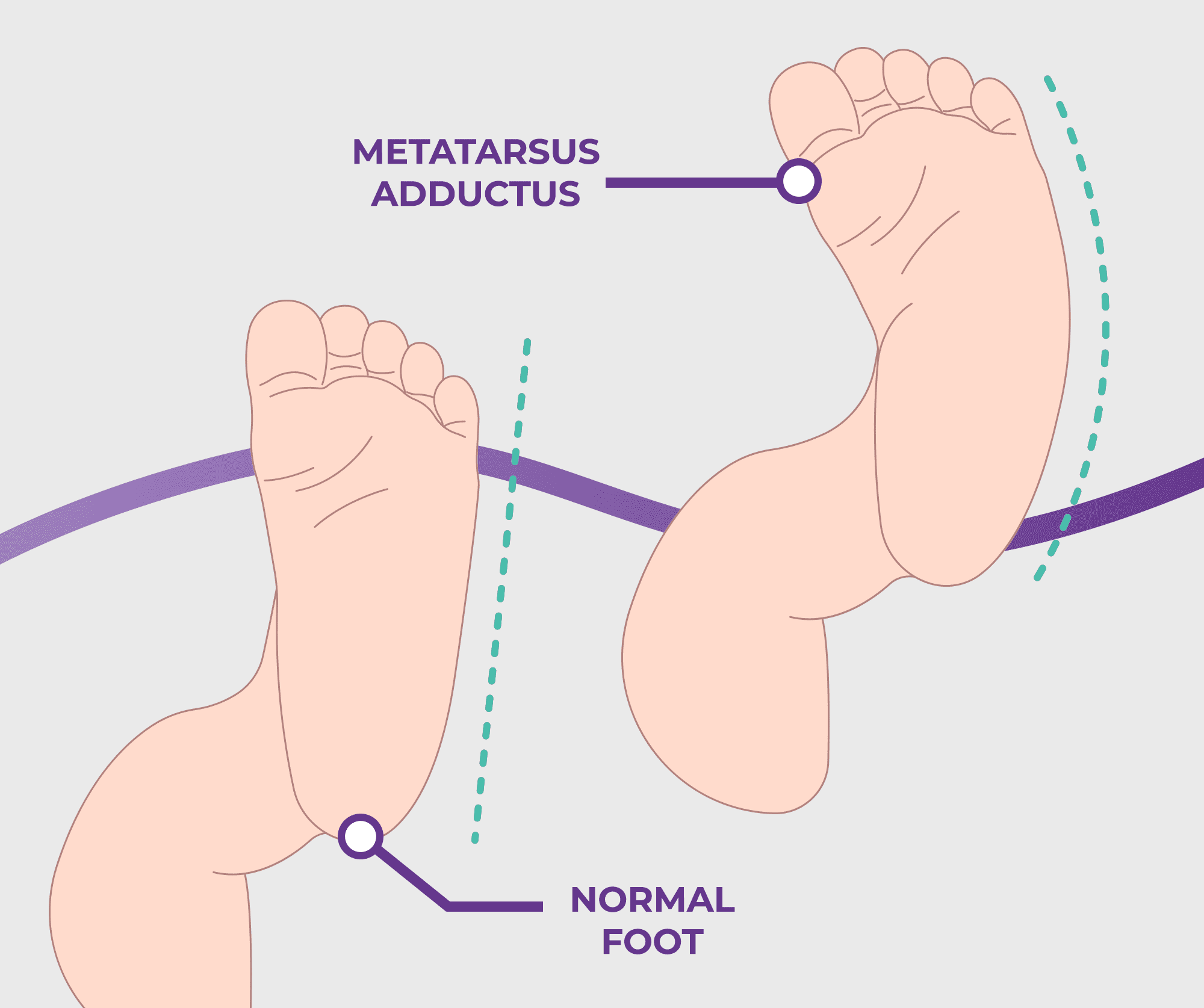 Metatarsus Adductus: Causes, Symptoms & Treatment