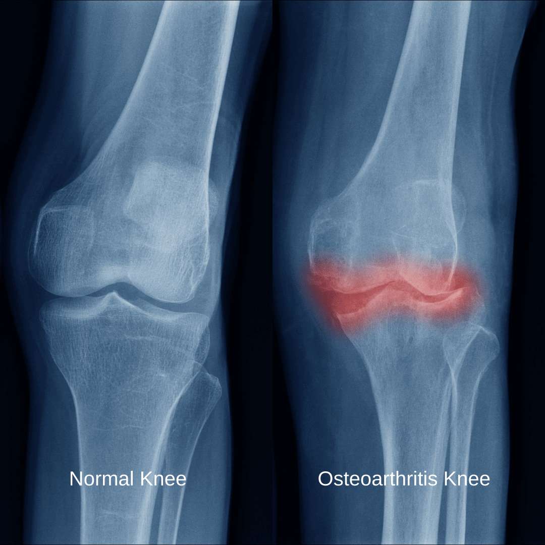 Osteoarthritis: Symptoms, Causes & Treatment | The Feet People Podiatry