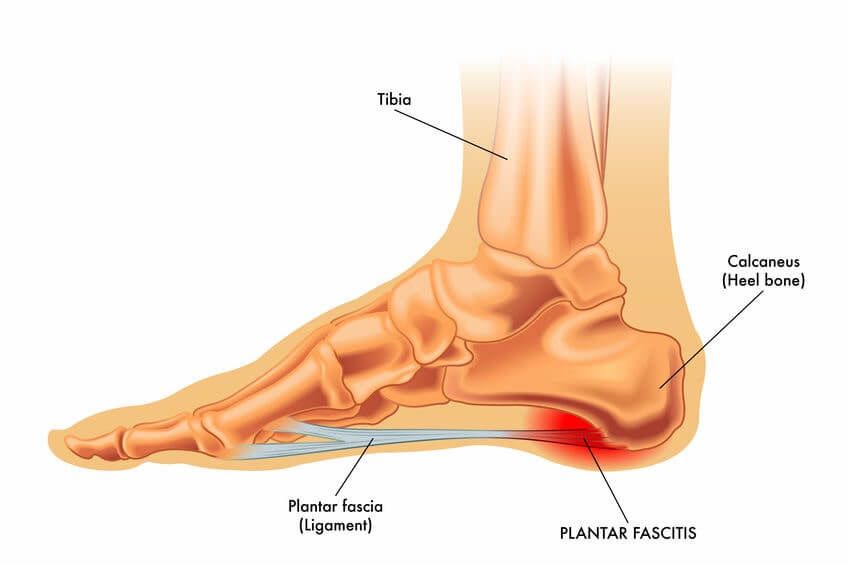 Plantar fasciitis diagram Diagram of a skeletal foot showing where plantar fasciitis occurs
