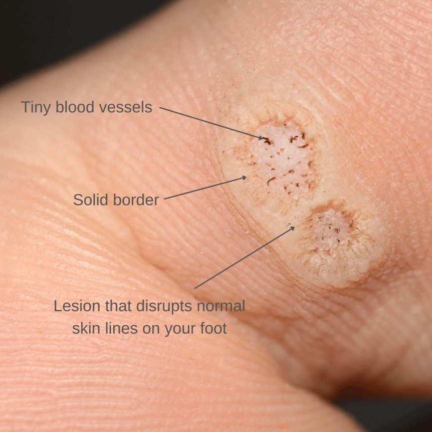 plantar wart removal stages
