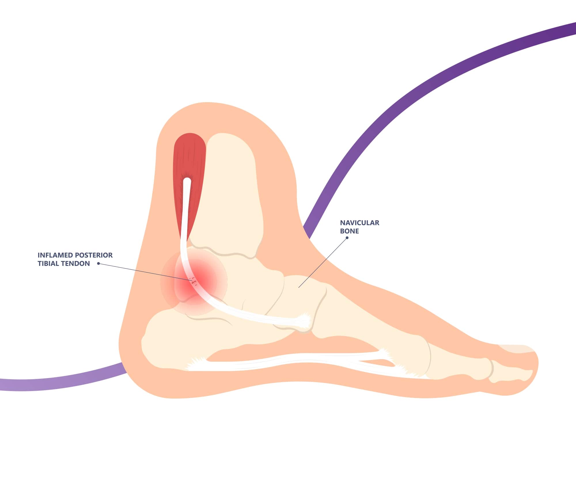 Posterior Tibial Tendon Dysfunction Causes Symptoms And Treatment 8147