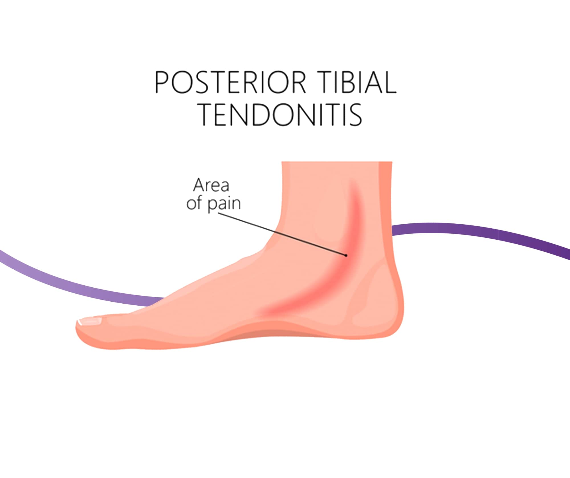 Posterior Tibial Tendon Dysfunction: Causes, Symptoms & Treatment