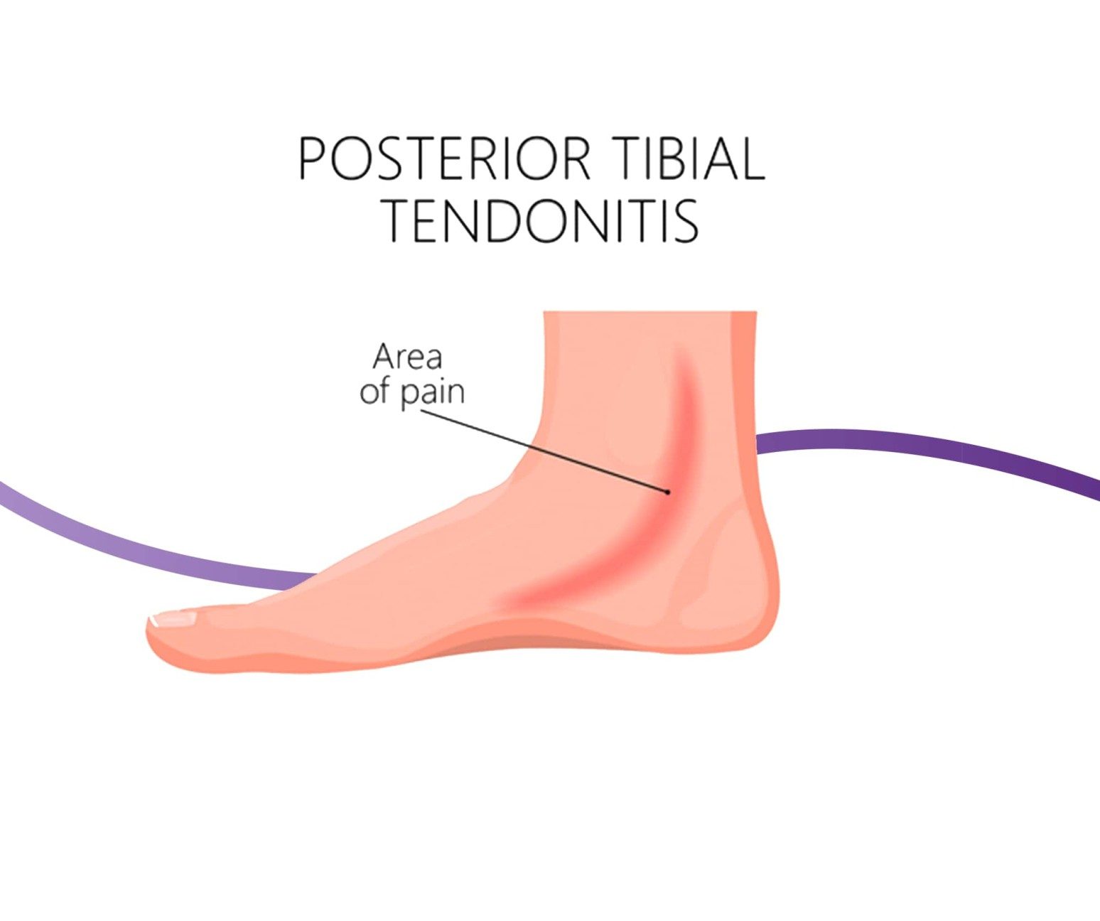 Posterior Tibial Tendon Dysfunction Causes, Symptoms & Treatment