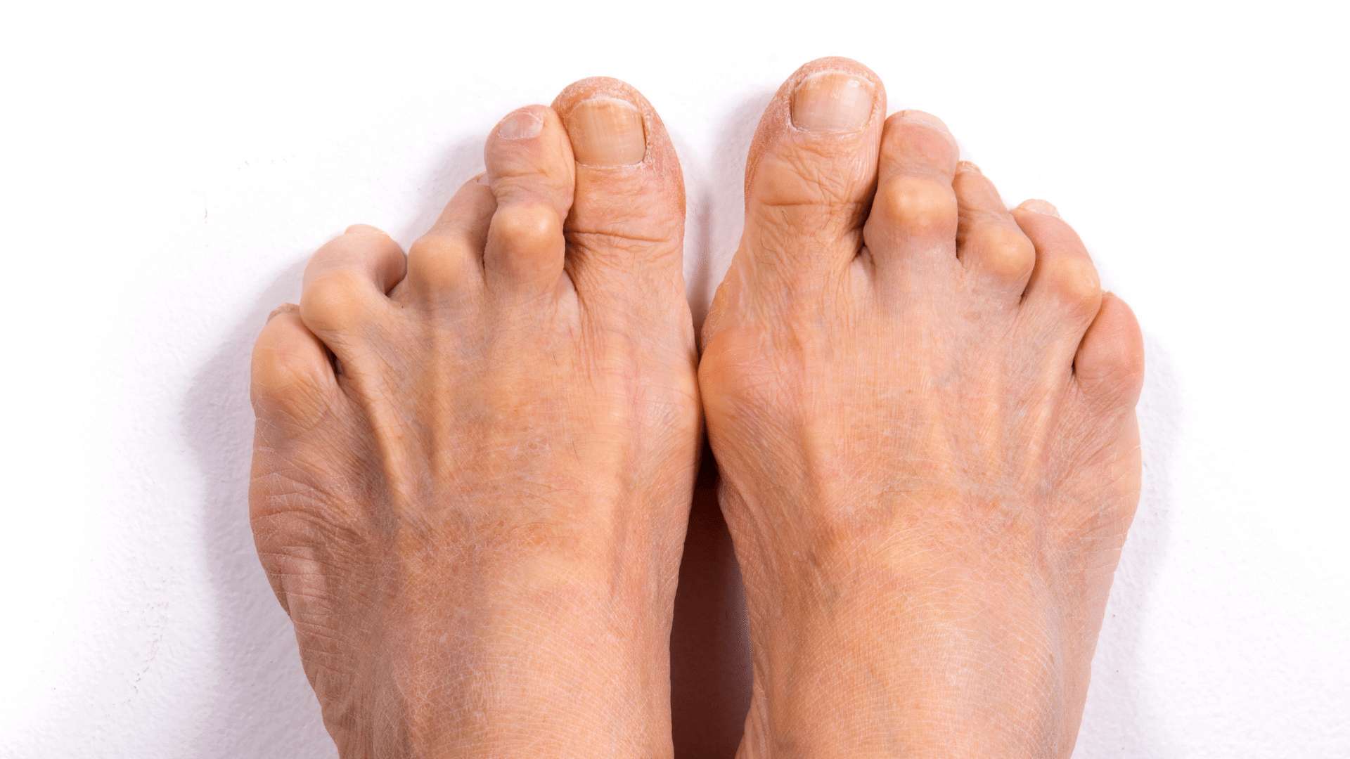 Rheumatoid Arthritis Symptoms, Causes & Treatment The Feet People