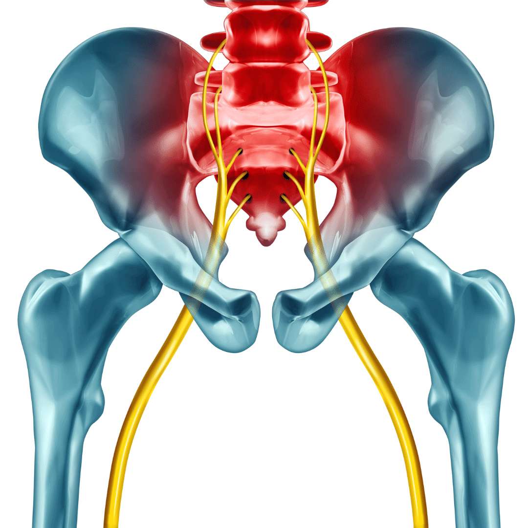 Sciatica pain The sciatic nerve that joins into the bones of the pelvis is experiencing sciatica pain
