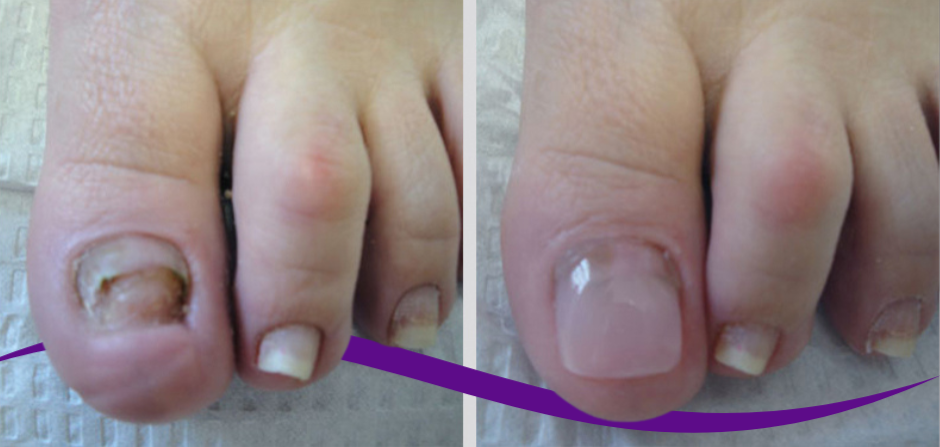 Three Ways To Transform The Appearance Of Your Toenails (Podiatrist Approved)