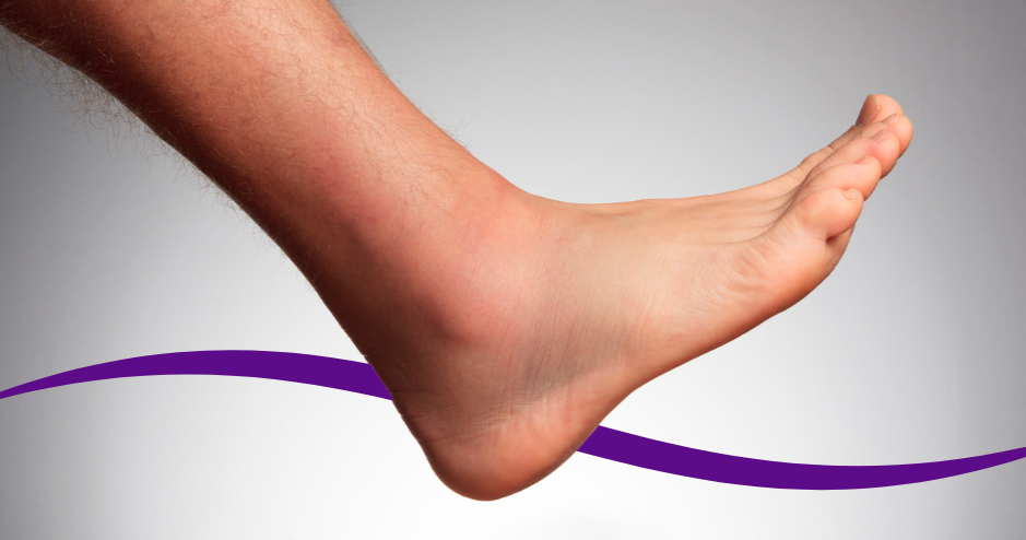 What Classifies A Foot As High Risk?